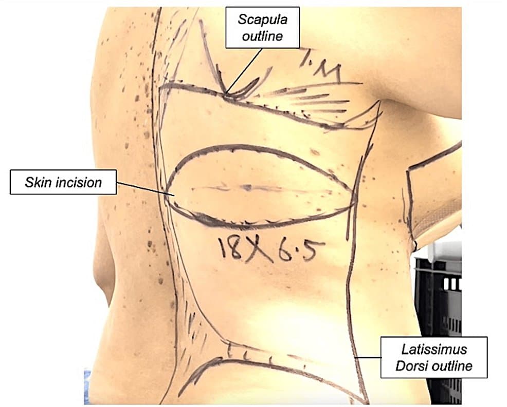 Free Latissimus Dorsi Pedicled Flap for PTRA right lower limb  - operative case photograph
